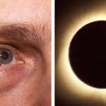 Daño ocular después del eclipse